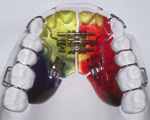 Ортодонтические пластинки